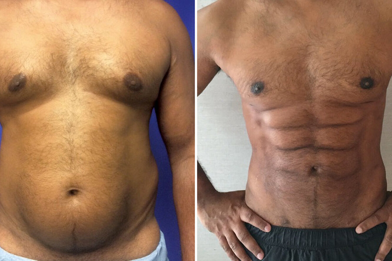 Убрать жир с живота мужчине хирургическим путем за неделю