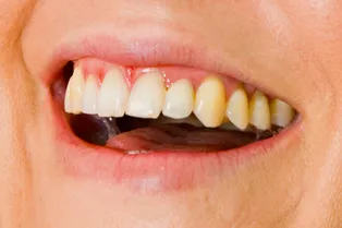 Американец заразился плотоядной инфекцией после укуса во время семейной ссоры