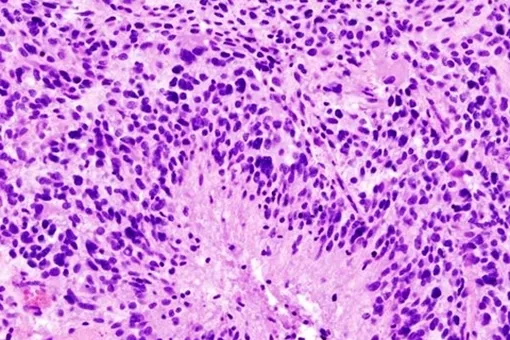 Рак мозга разрушает череп, это объясняет очень тяжелое развитие глиобластомы